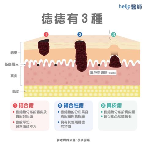 多痣體質|痣形成的原因？痣長毛、痣變多變大是痣病變？5招判。